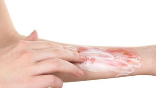 Quemaduras solares, de agua o aceite hirviendo 