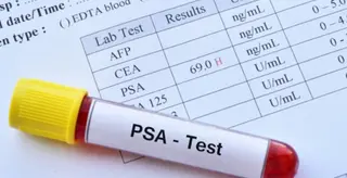 Prostate Analysis
