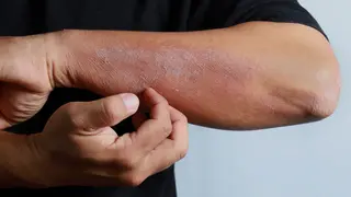 Tratamiento médico para el Acné, Psoriasis y Eccemas